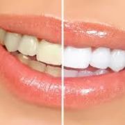 Dr. Jerry Vasilakos teeth whitening processes